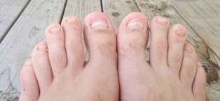 Nail fungus on your feet