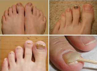 The symptoms of nail fungus