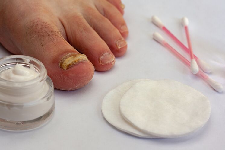 fungal toe treatment with fungal cream