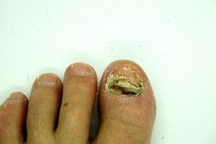 nail fungus - severe stage