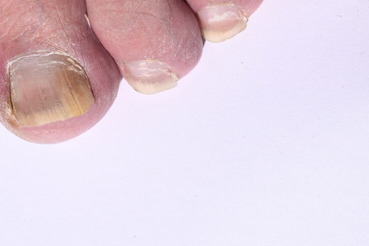 the initial stage of toenail fungus