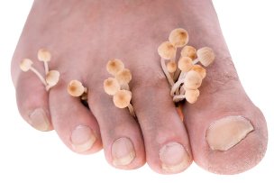 fungus on feet symptoms