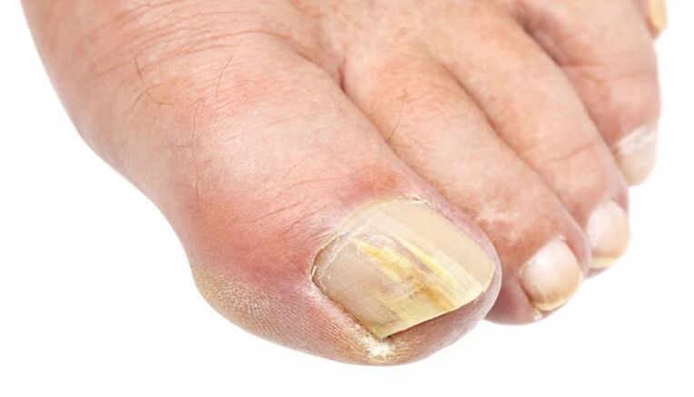 an external change in the nail is a sign of fungal infection