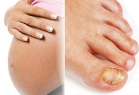 Pregnancy and nail fungus