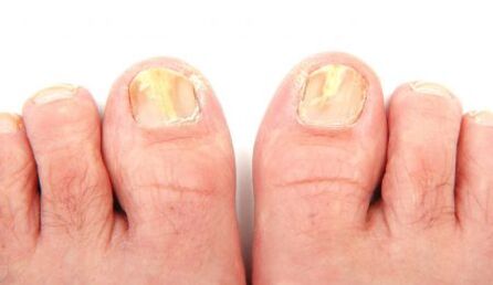 manifestations of nail fungus