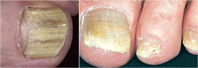 Advanced form of nail fungus