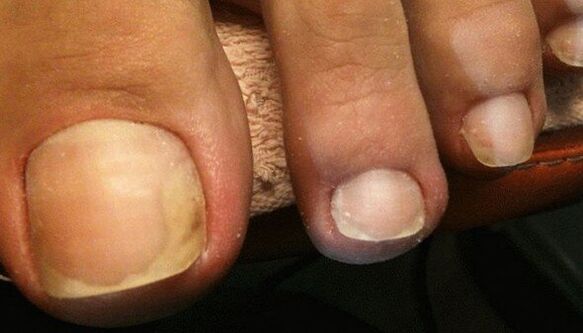 Signs of the initial stage of nail fungus