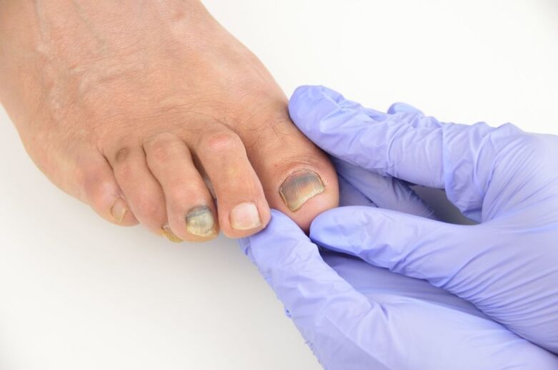 Medical examination of nails affected by fungus