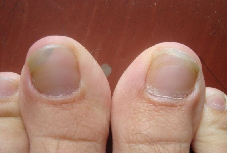 The initial stage of nail fungus