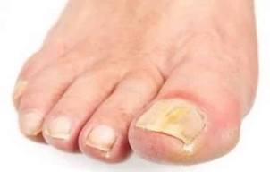 In the initial stage, the fungus nail foot