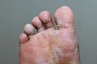 Heavy phase mycosis of the skin of the fingers on the feet