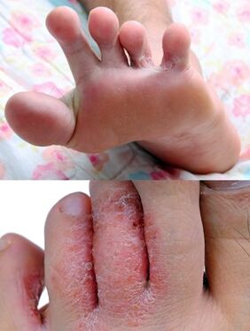 The foot fungus