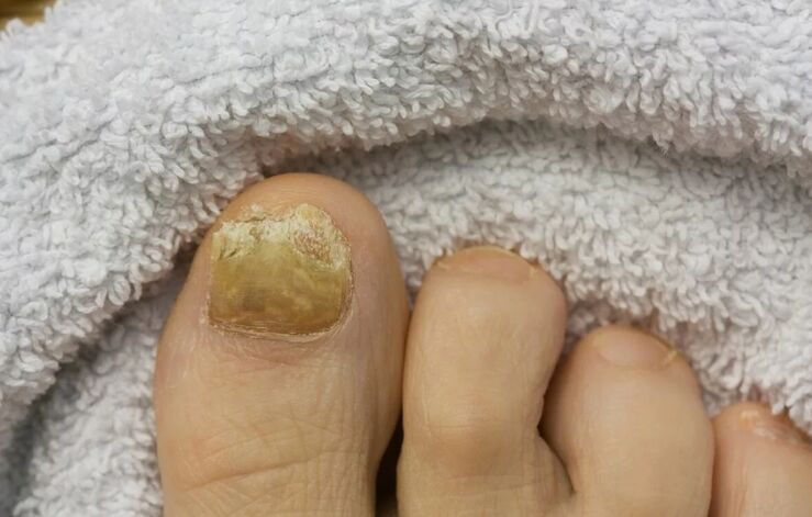 Nail mushroom