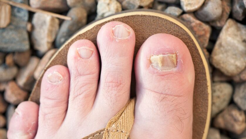 Nail onychomycosis