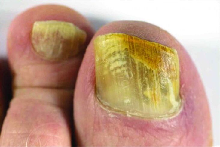 Sensation of the nail on the leg
